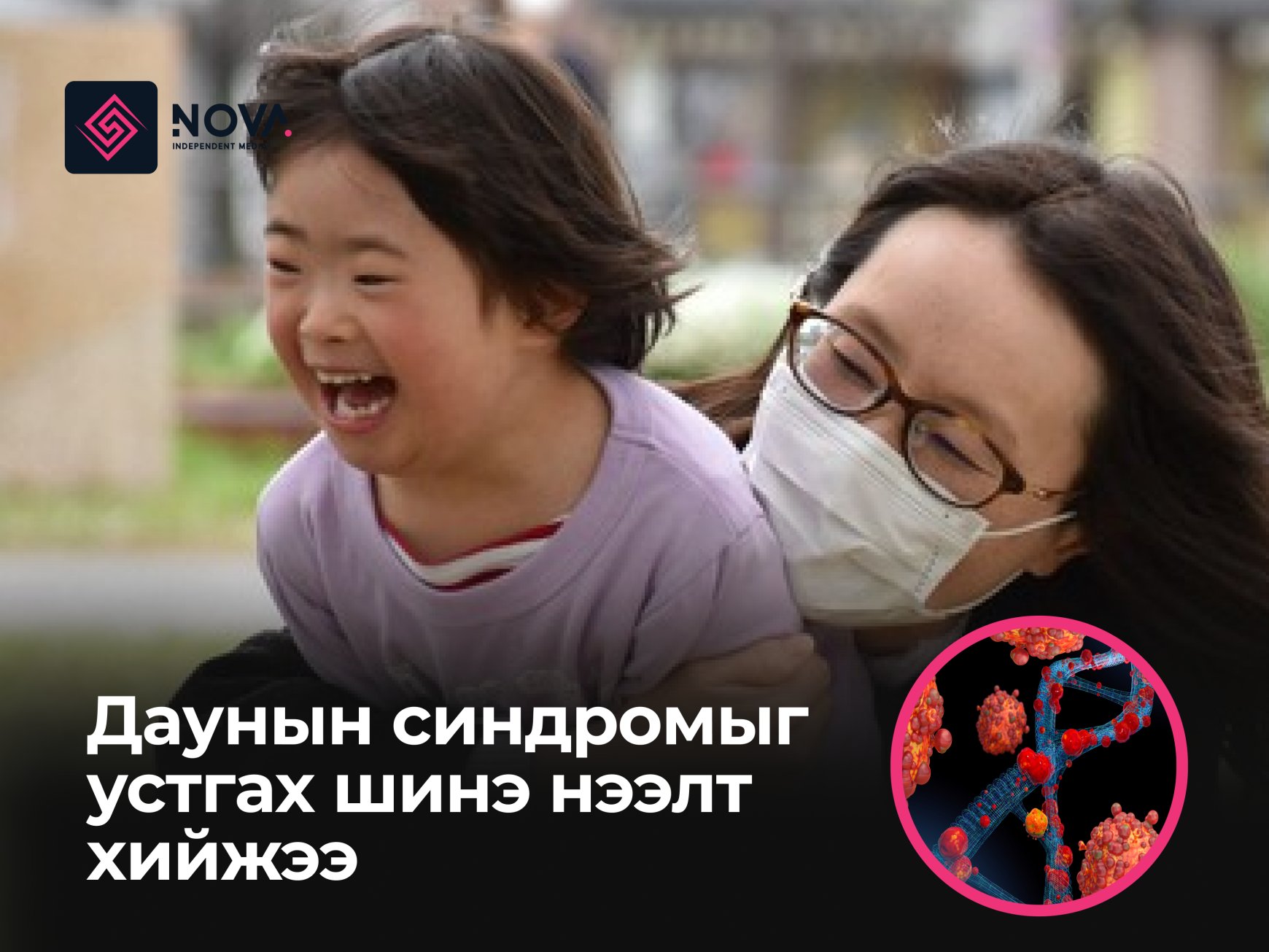 Дауны синдромыг эмчлэх боломжтой шинэ нээлт хийжээ