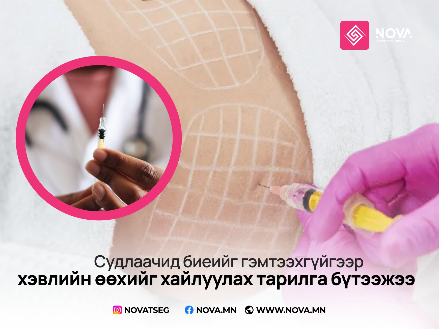 Судлаачид биеийг гэмтээхгүйгээр хэвлийн өөхийг хайлуулах тарилга бүтээжээ